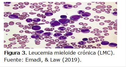  
Figura 3. Leucemia mieloide crónica (LMC). 
Fuente: Emadi, & Law (2019). 